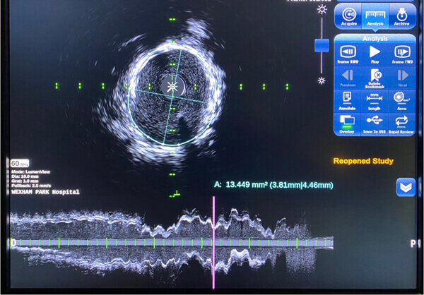 Precision PCI - Intravascular Ultrasound